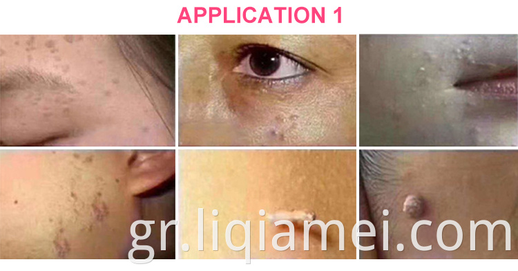 Laser Freckle Αφαίρεση Μηχανή Δέρμα Ετικέτα Αφαίρεση Pen Mole Dark Spot Face Wart Tag Remover Plasma Pen